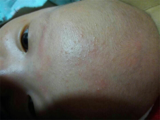 宝宝得湿疹怎么办，婴儿湿疹怎样好得快？