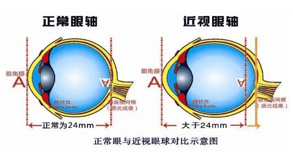 幼儿近视近视怎么办?能纠正吗